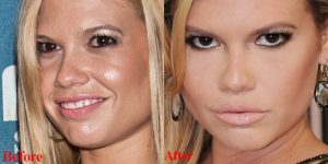 Channel West Coast Plastic Surgery Before And After