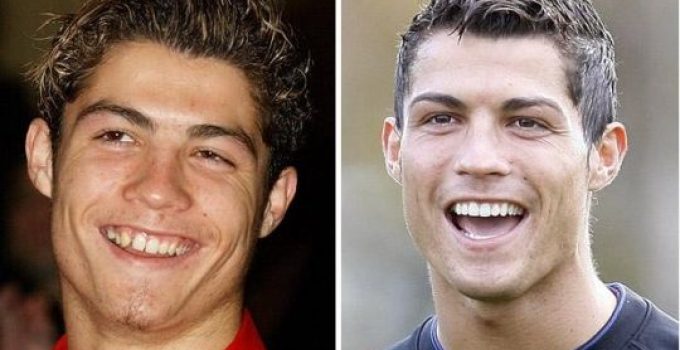 Cristiano Ronaldo Plastic Surgery Before And After Pictures 2023