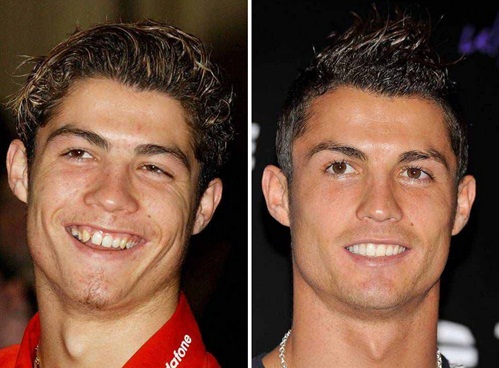 Cristiano Ronaldo plastic surgery