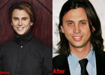 Jonathan Cheban Plastic Surgery Before And After Face Photos 2023