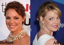 Katherine Heigl Plastic Surgery Before and After Photos 2022