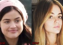 Lucy Hale Plastic Surgery Before and After Photos