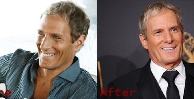 Michael Bolton Plastic Surgery Before and After Photos 2022