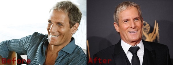 Michael Bolton Plastic Surgery Before and After Photos