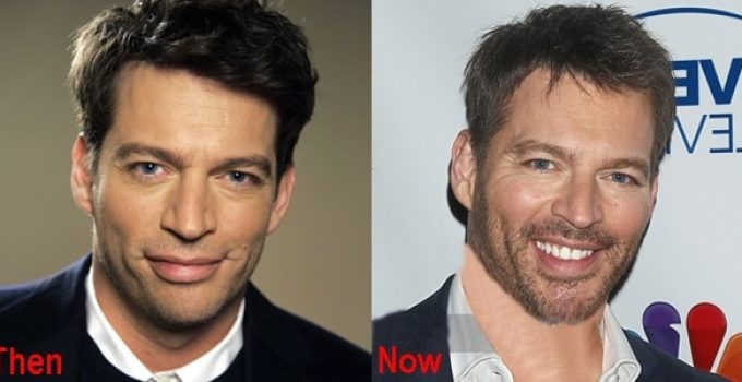 Harry Connick Jr Plastic Surgery Before And After Pictures
