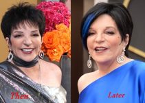 Liza Minnelli Plastic Surgery Before And After Photos