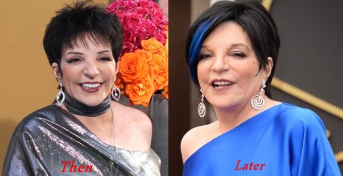 Liza Minnelli Plastic Surgery Before And After Photos
