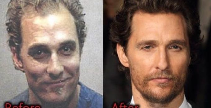 Matthew Mcconaughey Plastic Surgery Before And After Pictures