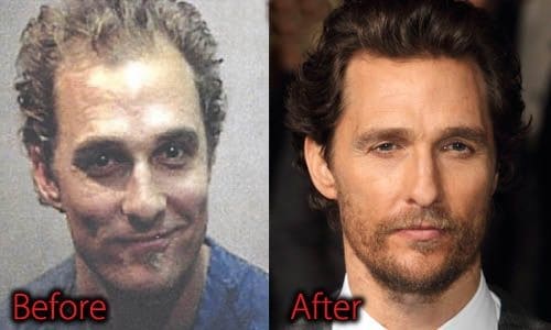 Matthew Mcconaughey Plastic Surgery Before And After Picture