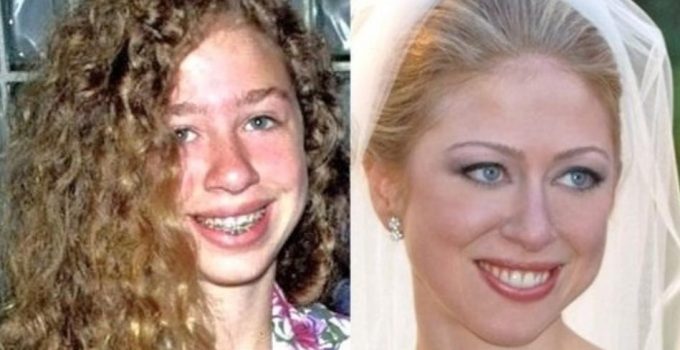 Chelsea Clinton Plastic Surgery Before And After Pictures