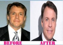 Bob Costas Plastic Surgery Before And After Photos