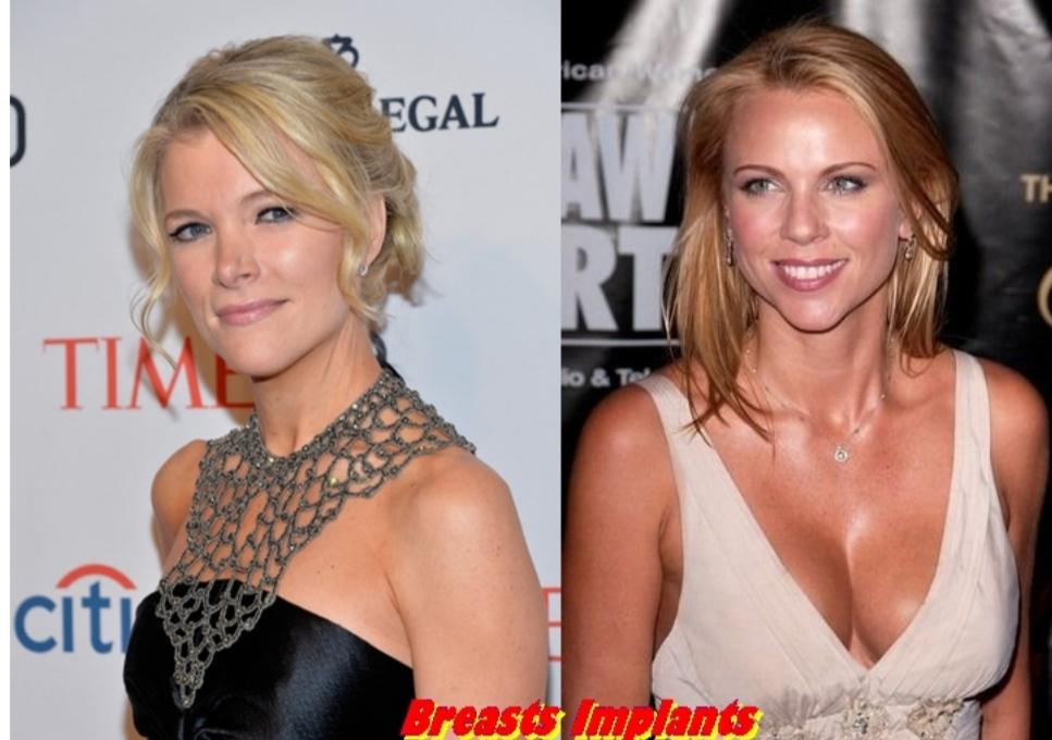 Megyn Kelly Plastic Surgery Before And After Breast, Nose Job Photos 