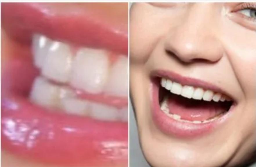 gigi hadid teeth